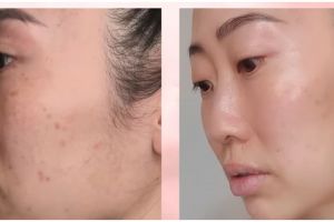 Pudar dalam 3 bulan, beauty vlogger ini hilangkan bekas jerawat dan flek hitam pakai 1 bahan makanan