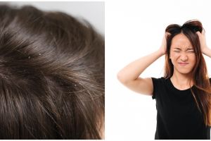 Rambut auto bersih, ini 11 cara menghilangkan ketombe basah dan kering di kepala pakai bahan dapur