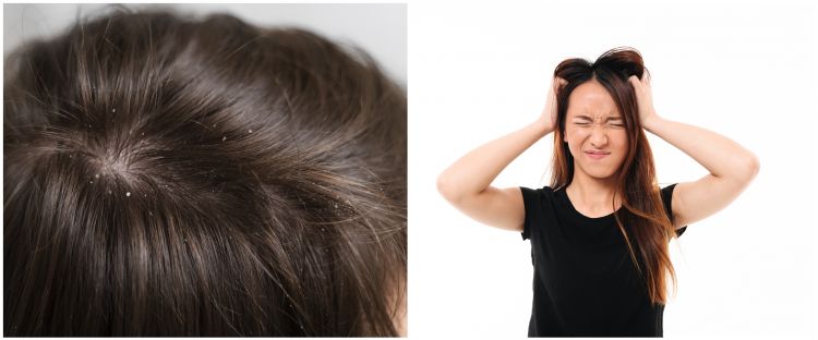 Rambut auto bersih, ini 11 cara menghilangkan ketombe basah dan kering di kepala pakai bahan dapur