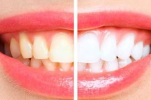 Tanpa garam, ini cara hempas noda kuning berkerak pada gigi pakai baking soda dicampur 1 jenis minyak