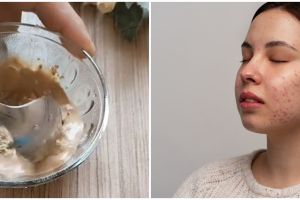 Tanpa acne patch, beauty vlogger ini tunjukkan cara hilangkan jerawat dengan masker dari 1 jenis buah