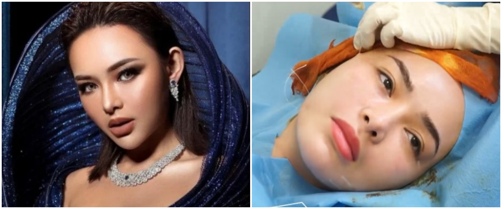 Wajah tirusnya bikin pangling, ini 9 momen Amanda Manopo jalani perawatan kecantikan tanam benang