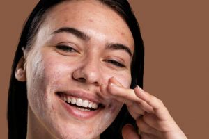 10 Kandungan skincare yang cocok untuk redakan jerawat meradang, wajah auto mulus