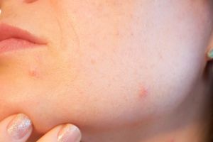 10 Rekomendasi acne patch di bawah Rp 50 ribu, biar nggak bikin infeksi