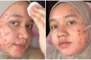 Riasannya simpel tapi bikin melongo, transformasi makeup cewek wajah penuh jerawat ini mulus pol