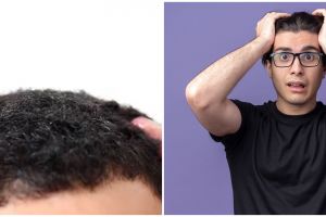 Tumbuh lebih lebat, YouTuber ini tunjukkan trik atasi rambut botak depan pakai 1 bahan rempah