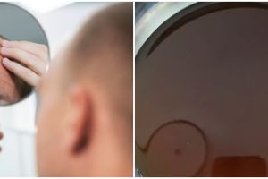 Tanpa tonic penumbuh, wanita ini bagikan cara suburkan rambut botak akibat rontok pakai 2 bumbu dapur