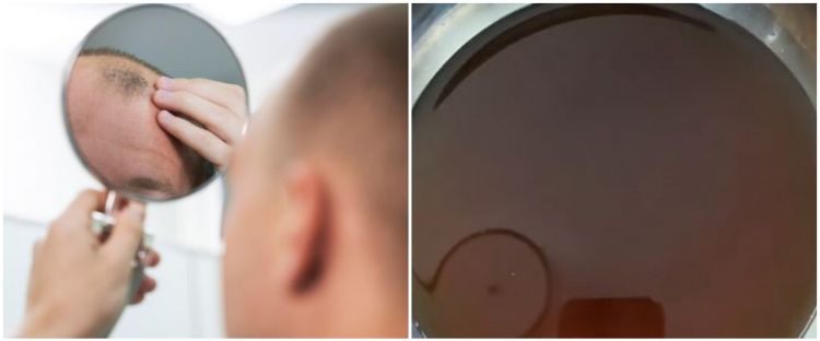 Tanpa tonic penumbuh, wanita ini bagikan cara suburkan rambut botak akibat rontok pakai 2 bumbu dapur