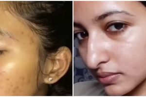 Tak perlu laser mahal, wanita ini bagikan cara pudarkan flek hitam di wajah pakai 3 bahan dapur