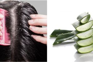 Kepala sering berketombe pertanda adanya masalah kesehatan, ini penyebab dan cara mengatasinya