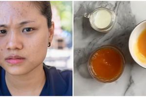 Nggak perlu lemon, TikToker ini bagikan cara atasi flek hitam akibat pigmentasi pakai 1 jenis buah