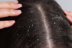 10 Rekomendasi produk untuk rambut berminyak harga di bawah Rp 150 ribu, bisa cegah ketombe