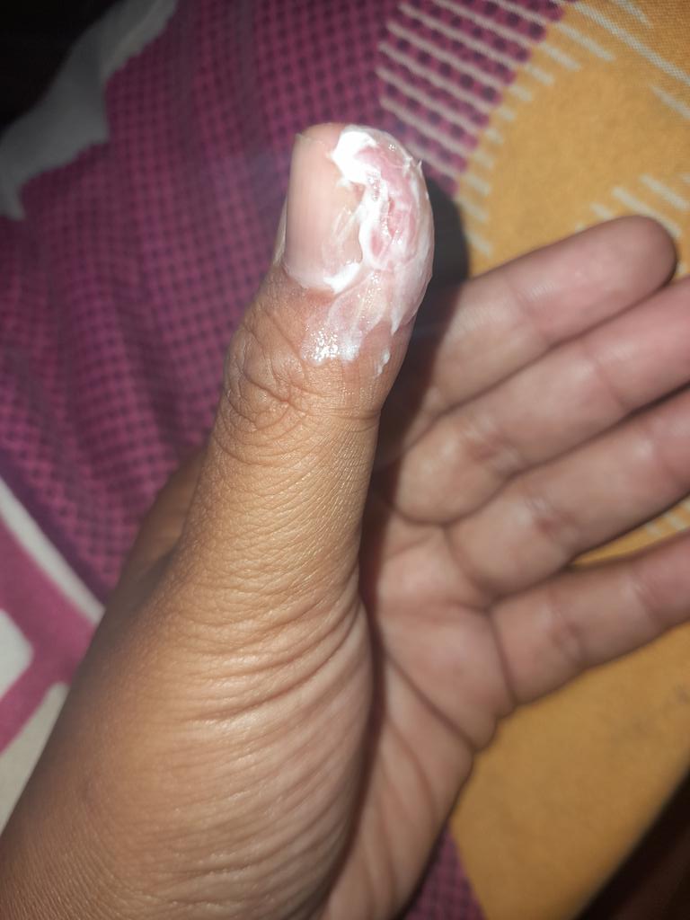 10 Cara ampuh atasi cantengan, solusi aman redakan bengkak dan nyeri