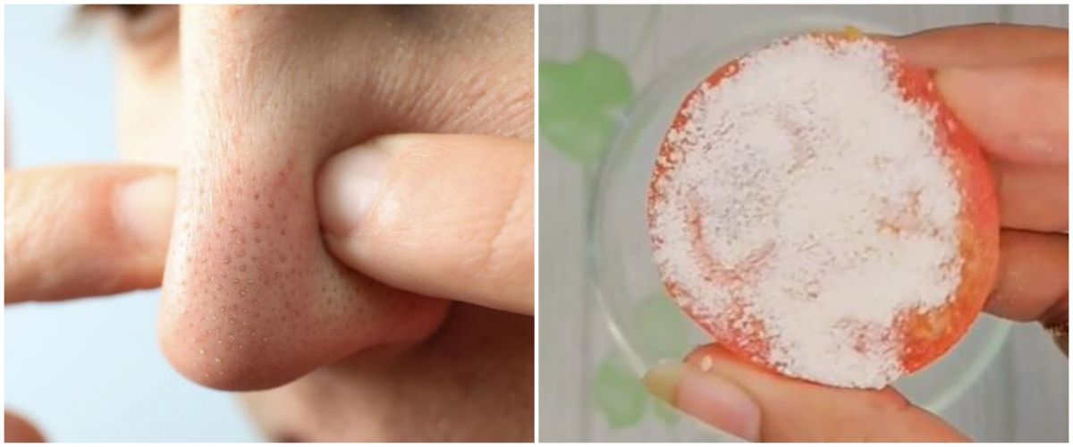 Without egg whites, this TikToker shares how to remove blackheads on the face using 2 kitchen