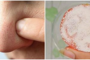 Tanpa putih telur, TikToker ini bagikan cara angkat komedo di wajah pakai 2 bahan dapur