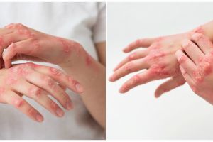 Penyakit scabies yang mudah menular, kenali pengertian, penyebab, dan cara mengobatinya