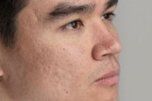 Tak perlu pore pack, cewek ini bagikan cara rapatkan pori-pori besar dengan scrub dari 3 bahan dapur