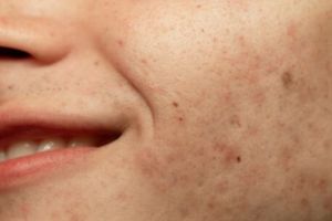 Tampak glowing dalam semalam, ini trik cerahkan wajah kusam akibat pigmentasi pakai 1 jenis bunga