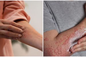 Waspada penyakit lupus, kenali penyebab, gejala dan cara mengatasinya