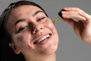 11 Rekomendasi serum jerawat untuk remaja harga di bawah Rp 100 ribu, wajah mulus antikemerahan