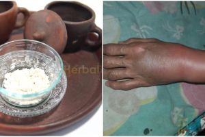 Bukan dikompres es batu, ini cara redakan memar membiru di kulit tangan pakai 1 bahan rempah