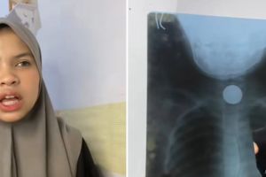 Curhat wanita nggak sengaja menelan uang koin ini bikin heran, dikeluarkan lewat jalur tak terduga