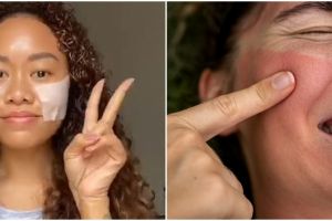 Cara atasi inflamasi pada wajah ini cuma 1 langkah, bikin kulit auto adem