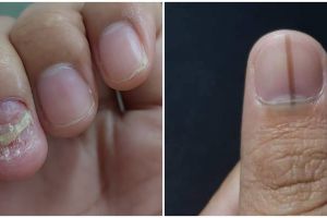 7 Kondisi perubahan kuku ini tanda adanya penyakit serius, jangan disepelekan sebelum terlambat