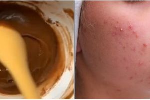 Tak pakai acne patch, YouTuber ini atasi kulit berjerawat gunakan madu dicampur 1 bahan rempah