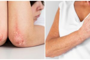 7 Cara ampuh menyembuhkan eksim tanpa konsumsi obat-obatan, cuma modal bahan alami