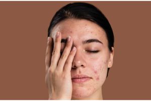 7 Rekomendasi produk YOU acne care, jerawat sembuh total