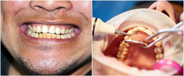 Tanpa campurkan baking soda, beauty vlogger ini bagikan cara hilangkan karang gigi pakai 1 bumbu dapur