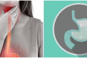 9 Komplikasi yang disebabkan karena asam lambung, ubah gaya hidup demi kesehatan jangka panjang