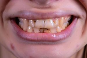 Tanpa perawatan ke dokter gigi, cewek ini unggah cara putihkan gigi kuning cuma pakai 3 bahan dapur
