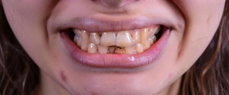 Tanpa perawatan ke dokter gigi, cewek ini unggah cara putihkan gigi ...