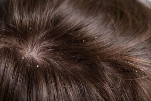 Nggak cuma lemon, TikToker ini unggah cara atasi ketombe membandel pakai tambahan 1 bahan dapur