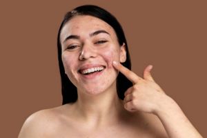 Sering dianggap sama, ini beda purging dan breakout serta cara mengatasinya