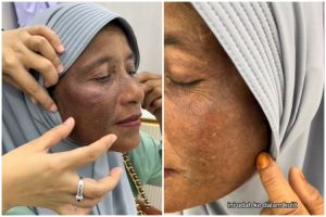 Kisah emak-emak pengen punya wajah glowing ini malah berakhir gosong, efek pakai skincare merkuri