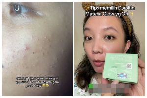 Niat glowing malah beruntusan, cewek ini bagikan cara bedakan produk Dorskin Matcha asli dan palsu