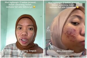 Niat hilangkan jerawat pakai retinol malah jadi breakout, kondisi pipinya bikin kaum cewek takut