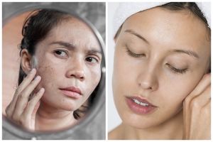 Cara hilangkan bekas jerawat menghitam cuma andalkan 1 sampah buah, kulit jadi auto cerah