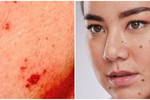 Bahaya akibat salah perawatan ternyata bisa sebabkan kanker kulit, begini penjelasannya