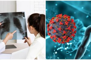 7 Makanan ini ternyata bikin penderita TBC makin parah, dari minuman bersoda hingga nasi putih