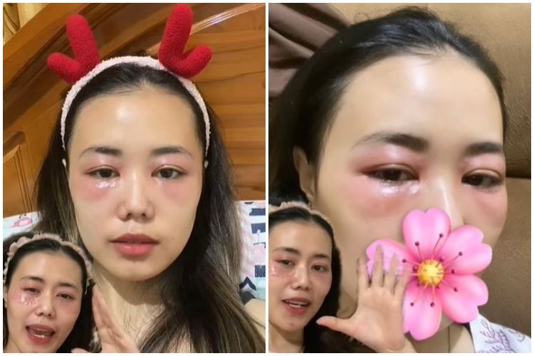 Lakukan treatment hilangkan mata panda malah berakhir iritasi, kulit cewek ini jadi bentol-bentol