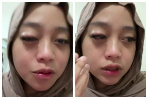 Akibat teledor menggunakan soft lens hingga mata kering, cewek ini alami iritasi hingga bengkak