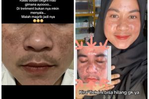 Wajah penuh flek hitam akibat hormon hamil dan merkuri, ini kisah perjuangan emak-emak cerahkan wajah