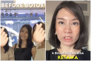 Treatment botoks biar cantik malah berakhir zonk, wajah wanita ini jadi kaku dan nggak bisa senyum