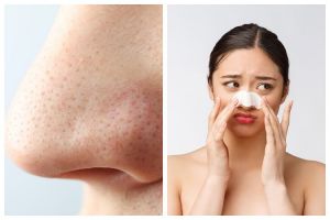 Pori-pori jadi bersih, ini cara hilangkan komedo di hidung pakai kombinasi baby oil dan 1 jenis minyak
