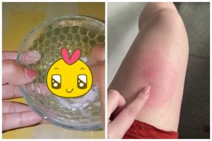 Tanpa dioles salep, ini cara redakan bekas gigitan serangga di kulit cuma tambah 1 bumbu dapur