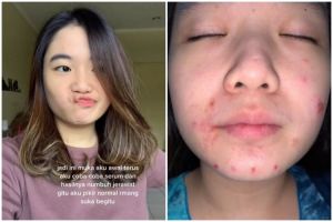 Wajah mulus cewek ini malah jerawatan parah usai pakai serum, akibat iseng gonta-ganti produk
